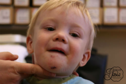 Ha! This is on the day the stitches came out, and Mr Average was there, and taking pictures.